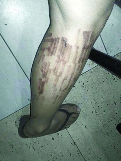 当事人接受脱毛后腿部呈"烫伤"状
